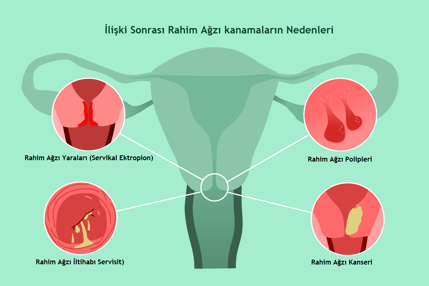 Cinsel İlişki Sonrası Kanama Nedir?